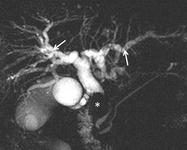 September 2008 MAGNETIC RESONANCE CHOLANGIOPANCREATOGRAPHY 971 in detecting and characterizing the cysts.