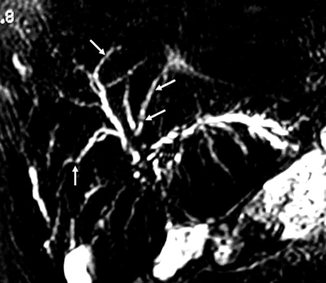 Finally, excessive contraction of the sphincter of Oddi may mimic an impacted stone. Vascular compression may cause artifactual narrowing of the biliary duct.
