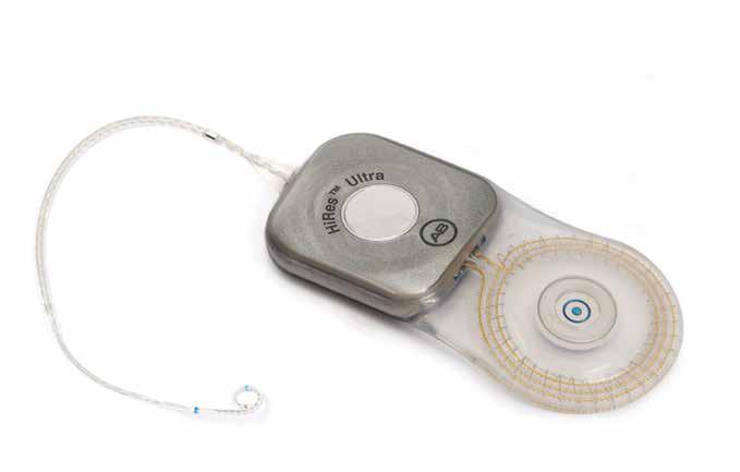 The HiRes Ultra implant is the newest member of the HiRes implant family and features advanced sound processing circuitry to provide unsurpassed programming flexibility, nearly unlimited ways to