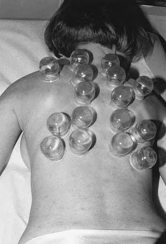 72 Cupping Therapy of Indicated Disorders and Complaints Fig. 8.3 Dry cupping on the entire back. In very thin patients, do not position cups on top of the shoulder blades.