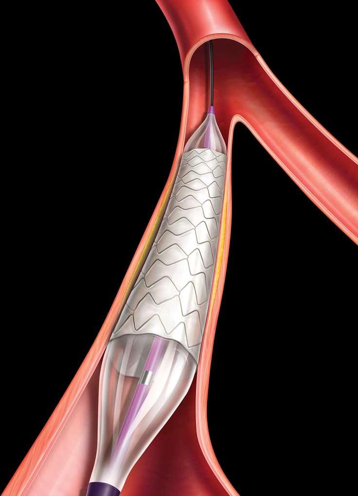 Summary Acute Outcomes: The LIFESTREAM Balloon Expandable Vascular Covered Stent was successfully deployed in 98.