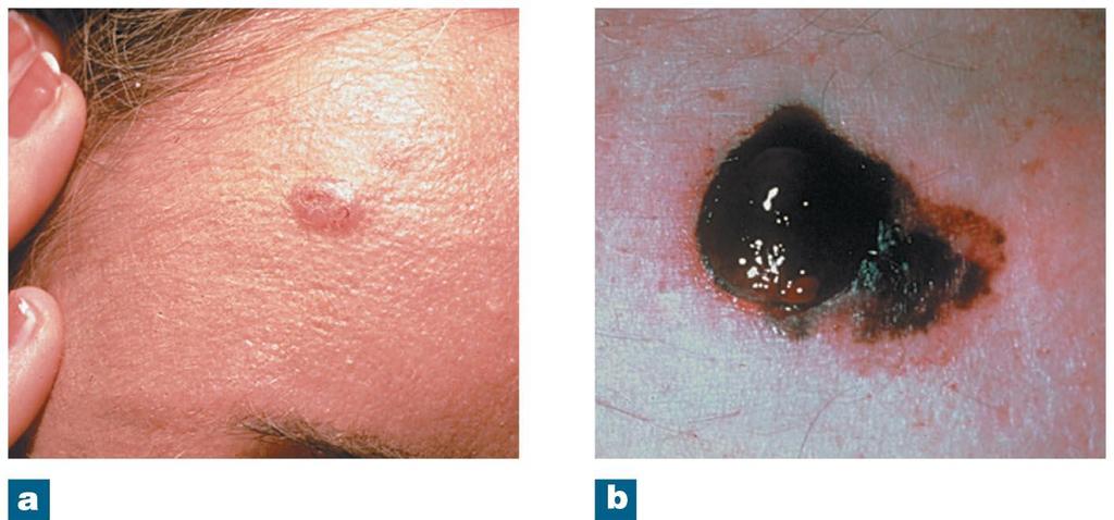 Figure 5-4 Skin Cancers.