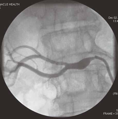 renal atheroembolization. Although it is logical that embolic protection devices are needed during renal artery intervention, very limited data exist in the literature to support its use.