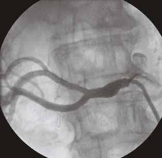 DISCUSSION There is much evidence that atheroembolization occurs in many vascular interventions, especially during carotid artery and saphenous vein graft stenting procedures.