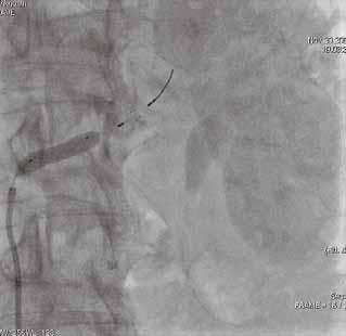 Figure 7. Left renal artery stenting with embolic protection.