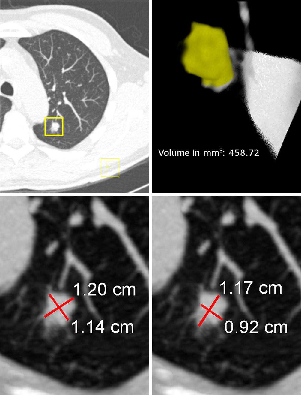 54 Han et al. Volume versus diameter assessment of small pulmonary nodules A C B D study, where Pinsky et al.