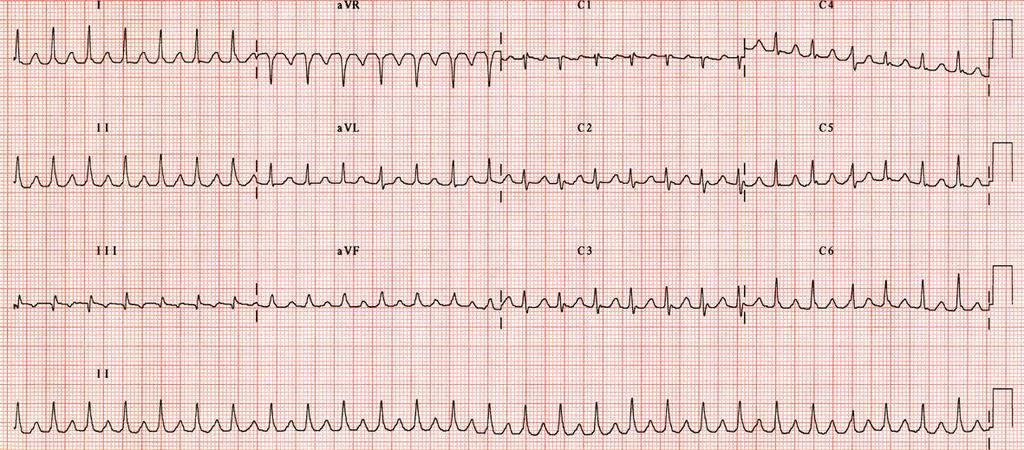 1. Atrial Tachycardia 1a. What is the diagnosis? 2.