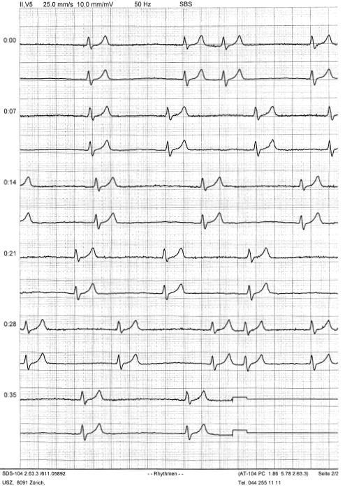 6. What is the diagnosis? 1. Ischemia 2. Myocardial Infarction 3.
