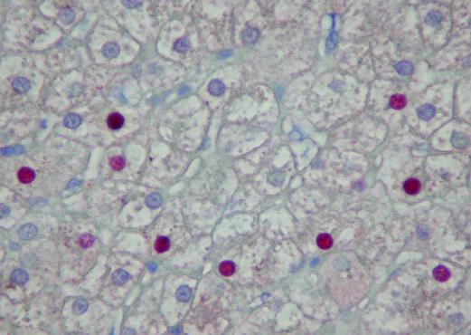 of the cytoplasm indicative of hepatitis B surface antigen within dilated endoplasmic reticulum (arrows).