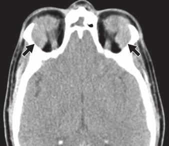 Lacrimal Gland Masses ownloaded from www.ajronline.org by 148.251.232.