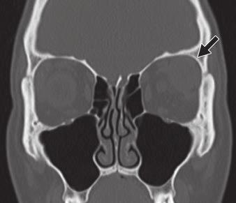 (arrows, ), which divides lacrimal gland into posterior-superior