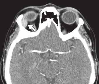 right sphenoid bone (white arrows, and ).