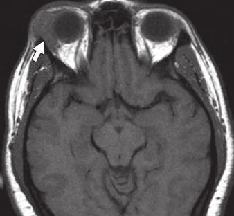 Lacrimal Gland Masses Fig. 6 Lymphoid hyperplasia.