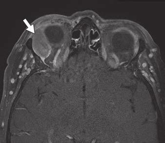 T2-weighted () MR images show right lacrimal mass involving both