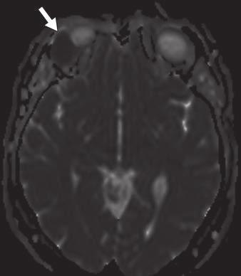 hypointense to muscle on T1-weighted image, isointense to brain cortex