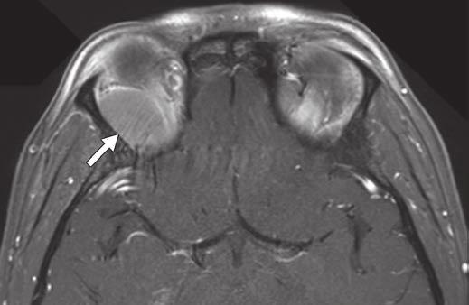 and, oronal () and axial () gadolinium-enhanced T1-weighted MR images