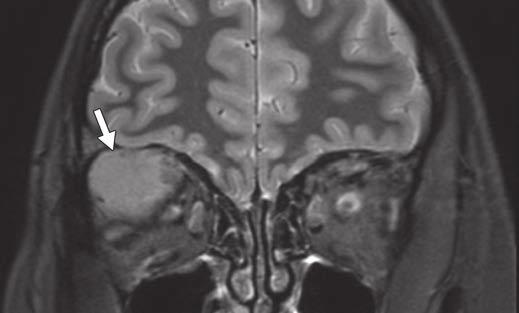 Lacrimal Gland Masses ownloaded from www.ajronline.org by 148.251.