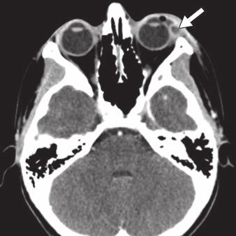 diffusely enlarged and enhancing left lacrimal gland (arrows).