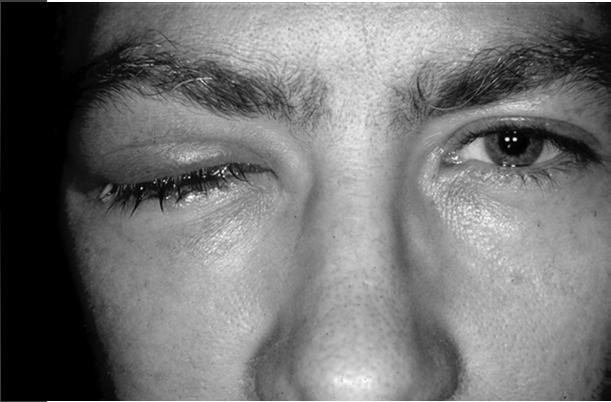 Eyelid or facial trauma Upper