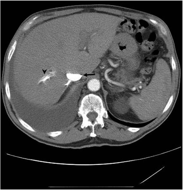 CHEST Postgraduate Education Corner PULMONARY AND CRITICAL CARE PEARLS A 74-Year-Old Man With an Incidental Right-Sided Pleural Effusion Joshua D. Farkas, MD ; Sahar Amery, MD ; Mark B.