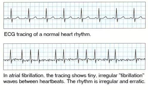 Electrocardiograph The tracing