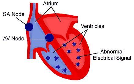 Ventricular Fibrillation This is a condition where the