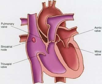 Heart Murmur A condition that occurs when one or more of the heart valves does not open or close