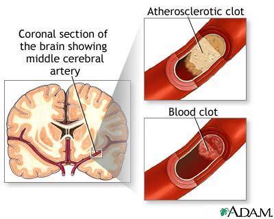 Stroke A condition that occurs when a blood clot blocks an artery going to