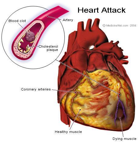 Heart Attack A condition that occurs when a blood clot blocks an artery going to the heart muscle and
