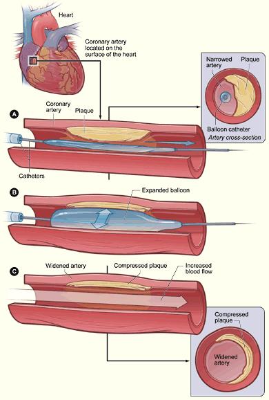 Angioplasty A procedure in which a fine plastic tube is inserted into a clogged artery, a tiny