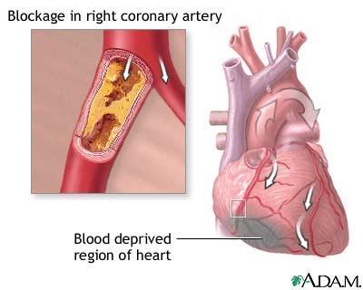 Coronary Bypass Surgery A common surgical procedure in which a segment of healthy blood vessel