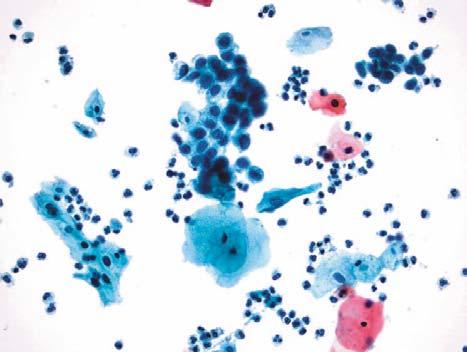 It is likely that within very few years most, if not all, cervical cytology in Canada will be liquid-based.