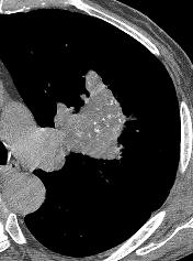 Calcified Lung Carcinoma Calcium detectable by CT in 10% Usually 2 dystrophic ca++ or