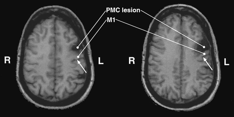 Motor cortex and finger sequences 1705 Fig. 9 T 1 -weighted conventional MRI (axial slices) showing a chronic ischaemic lesion of the left lateral PMC, area 6, in a 44-year-old female patient.