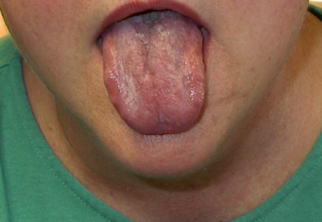Tongue in Obesity based Sleep Apnea Face in