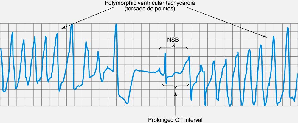 LONG QT SYNDROME AND TORSADE DE POINTES One of common causes of proarrhythmia druginduced significant new arrhythmia or worsening of an existing arrhythmia Antiarrhythmic drugs, groups 1A and 3