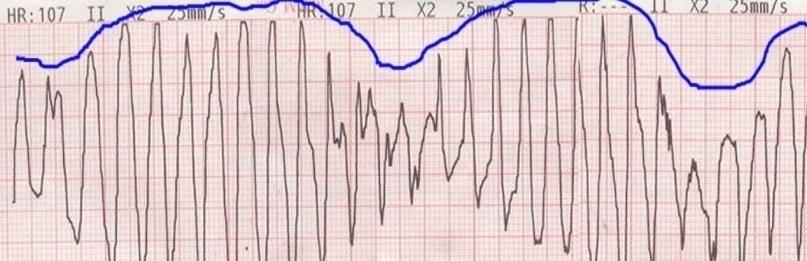 LONG QT SYNDROME AND TORSADE DE POINTES Torsade de Pointes (TdP, twisting the points ) is a rapid form of polymorphic VT associated with evidence of prolonged ventricular repolarization (long QT