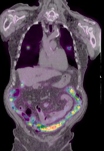 PET/CT All 3 lesions are hot on