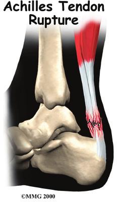 Gastroc-soleus muscle group Introduction Problems that affect the Achilles tendon include tendonitis, tendinopathy, tendocalcaneal bursitis, and tendonosis.