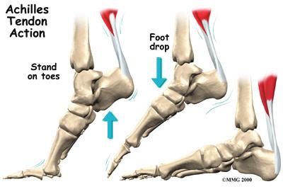 This guide will help you understand where the Achilles tendon is located what kind of Achilles tendon problems there are how an injured Achilles tendon causes problems what treatment