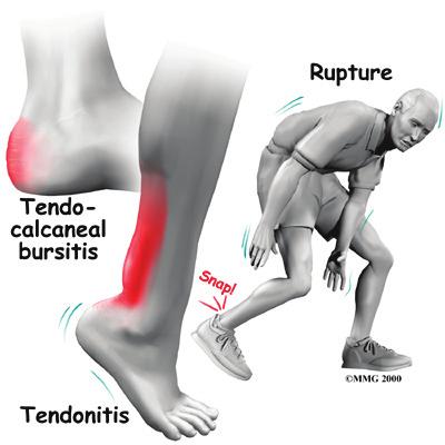 bursae, are found in many places in the body. When a bursa becomes inflamed, the condition is called bursitis. Tendocalcaneal bursitis is an inflammation in the bursa behind the heel bone.