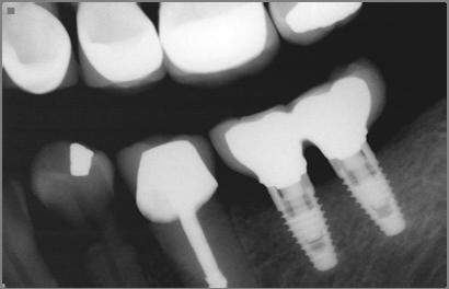 Minimally Invasive Implant Dentistry Using Narrow, Shorter and Mini Implants Jose Luis Ruiz DDS, FAGD Statistics show that 69% of adults ages 35 to 44 have lost at least one permanent tooth to an