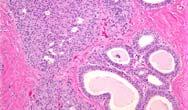 ADH DCIS Tubular carcinoma Lobular neoplasia Conclusions Columnar cell lesions and flat epithelial atypia are being