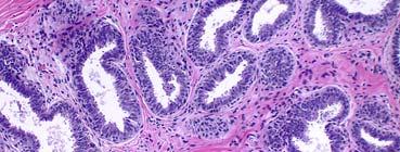Columnar Cell Hyperplasia TDLUs with