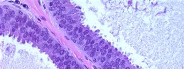 carcinoma (monomorphic type) Columnar