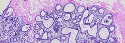 Columnar cell hyperplasia with atypia
