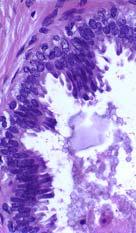 Columnar Cell Change Columnar Cell Hyperplasia vs Non-Atypical Columnar Cell Lesions Can Pathologists Reproducibly Distinguish Columnar Cell Lesions