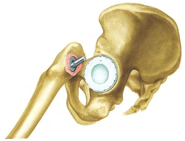 Surgical Technique System Description 7 Rasp Stem seated in the Femur The rasp is then left in situ.