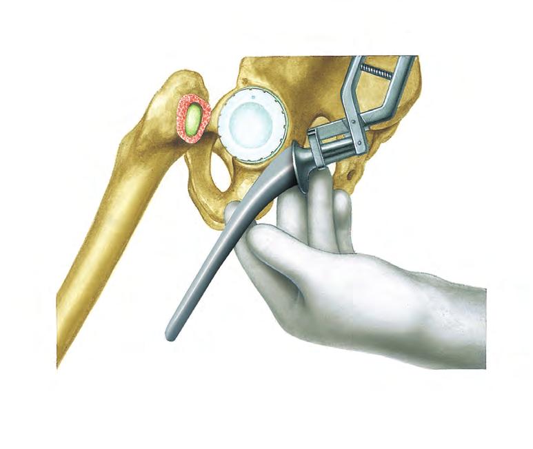 Surgical Technique System Description 13 Implantation of Stem The improved cementing technique requires an introducing forceps to place the femoral component into the femur.