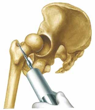 6 Preparation of Proximal Femur Driving in rasp stem with handle mounted Always start with the smallest rasp stem (item no.